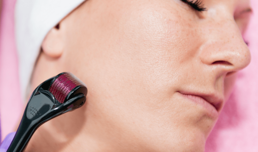 <p style="font-family: 'Poppins', sans-serif; font-weight: 700; font-size:24px;">MICRONEEDLING</p>