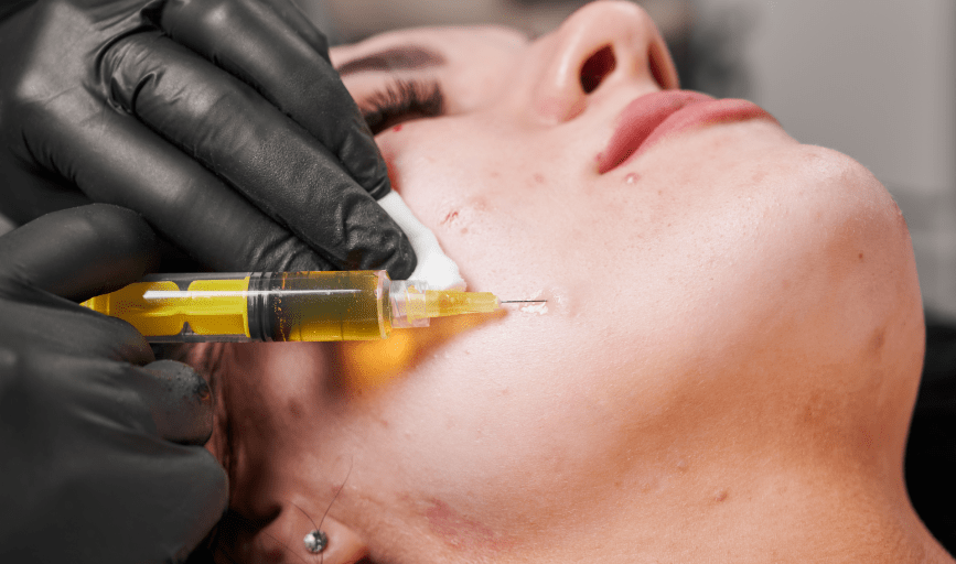 <p style="font-family: 'Poppins', sans-serif; font-weight: 700; font-size:24px;">PRP FACIALS</p>